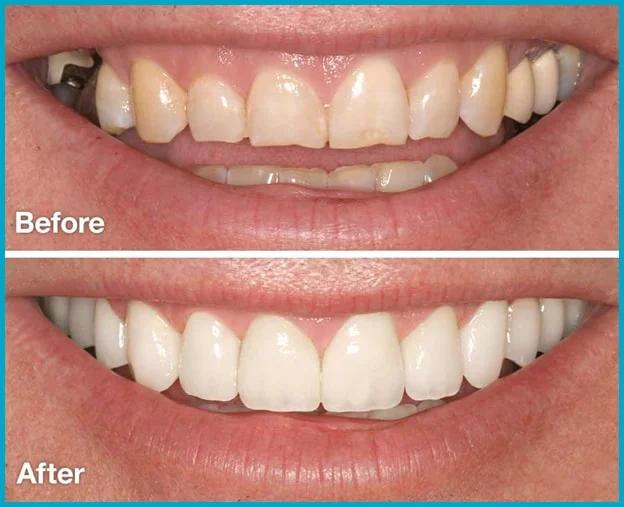 Smile Design