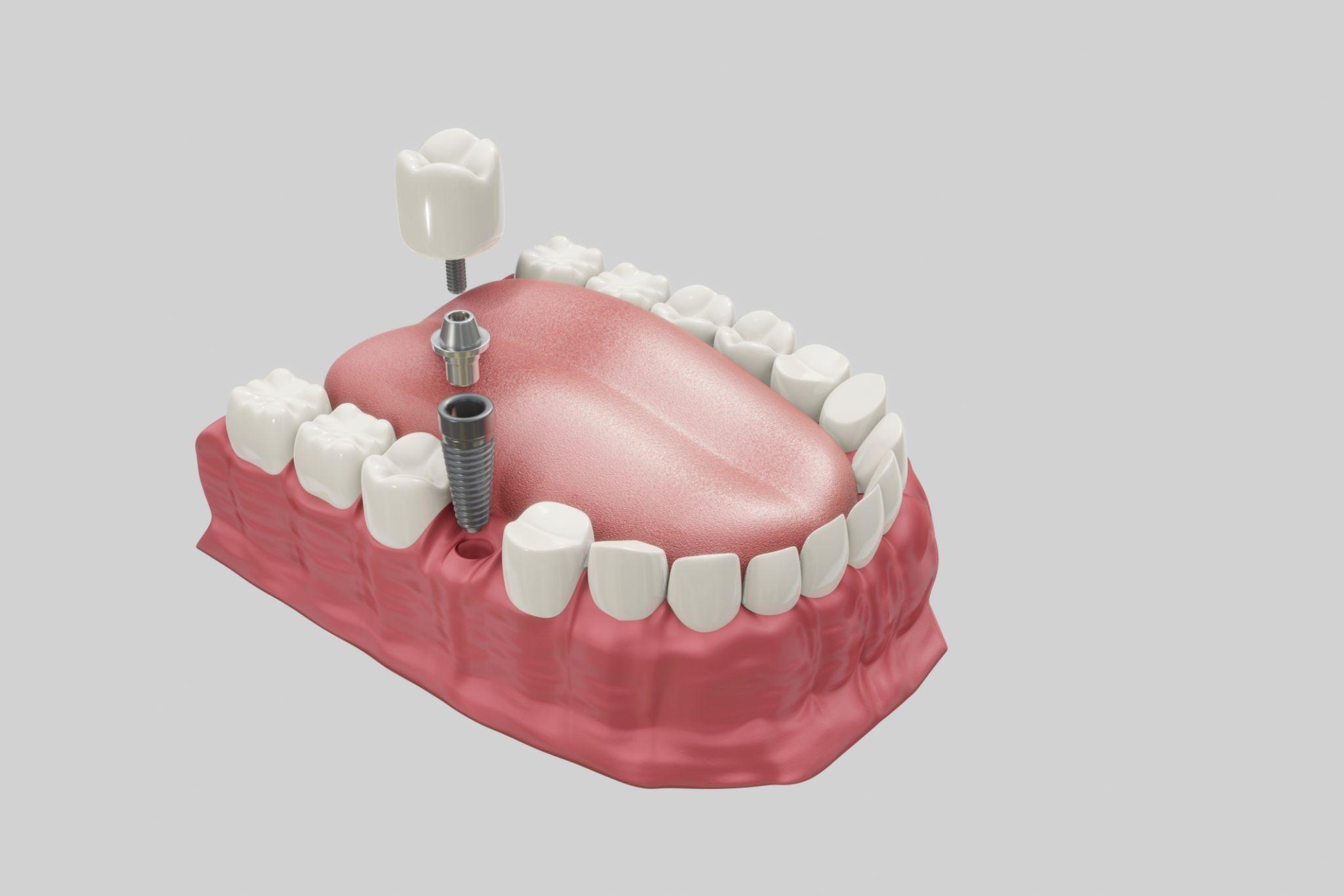 Dental Veneers